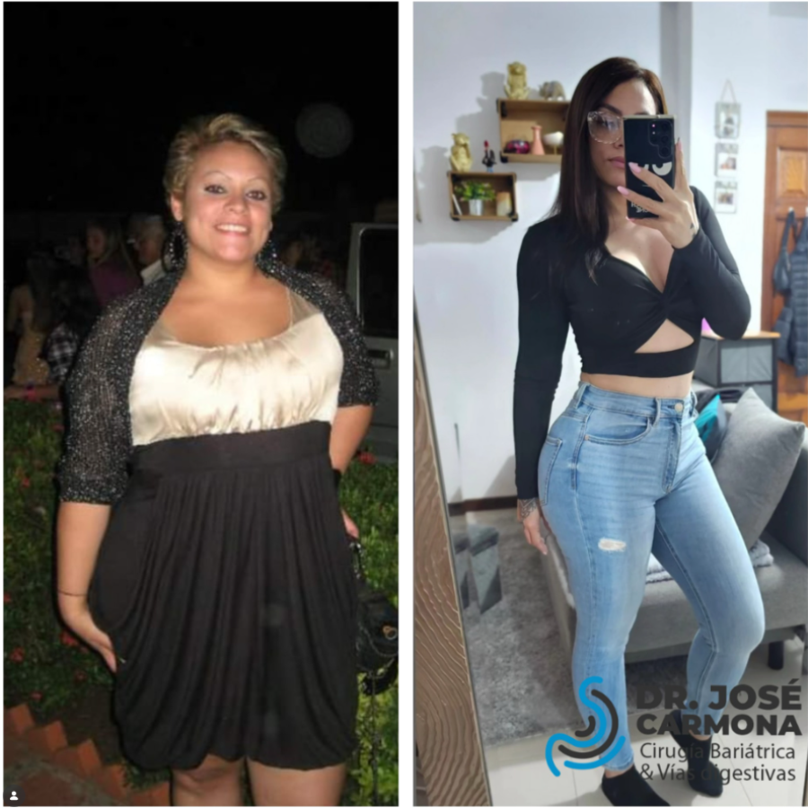 Maryeling Soler Paciente bariatrico Dr. Carmona