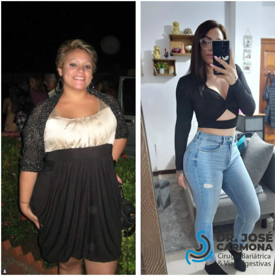 Maryeling Soler Paciente bariatrico Dr. Carmona
